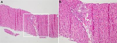 Autosomal dominant chronic mucocutaneous candidiasis with STAT1 mutation can be associated with chronic active hepatitis: A case report